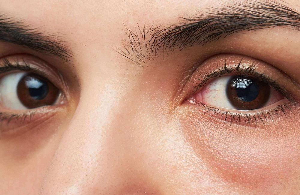 3 Dermatologist-Approved Hacks For Reducing Puffiness And Under Eye Bags -  SHEfinds